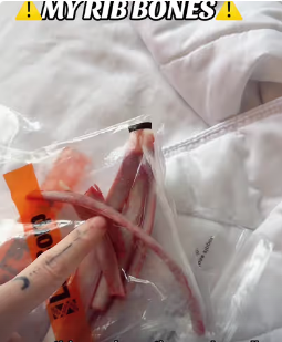 rib removal surgery
